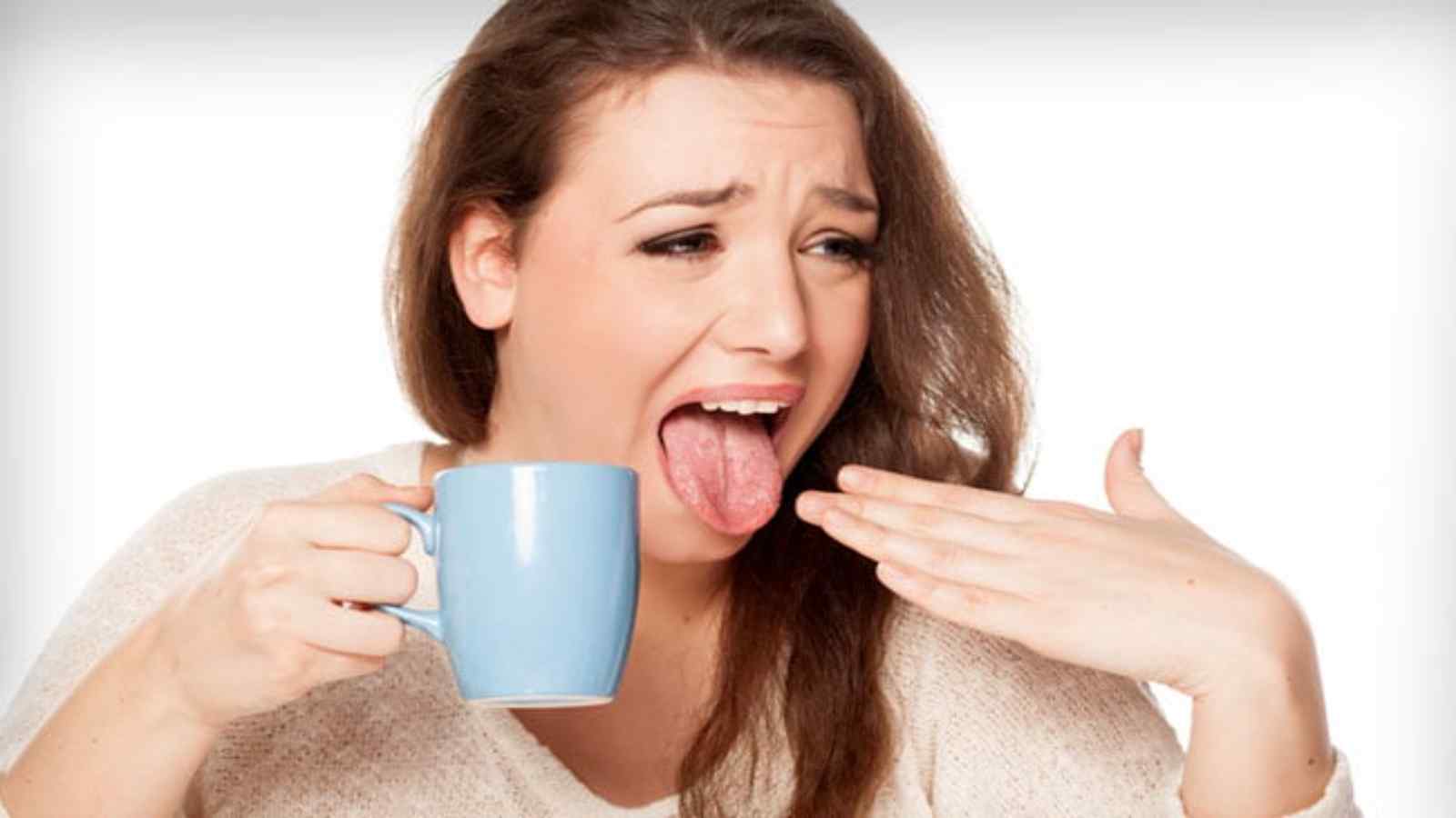 Five Natural Remedies to Soothe Your Burnt Tongue