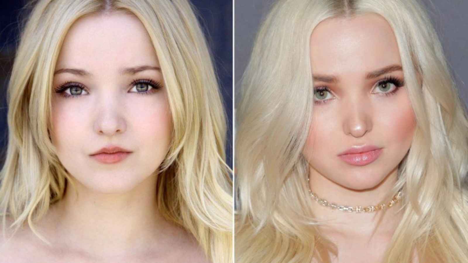Dove Cameron before and after Plastic Surgery looks