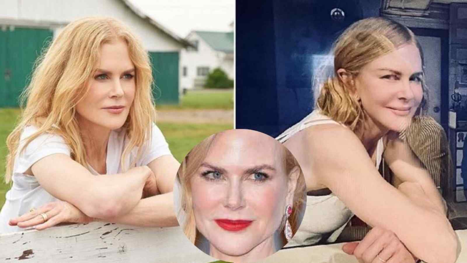 Nicole Kidman (1) Nicole Kidman Plastic Surgery: Nose Job, Filler, Chin Implant