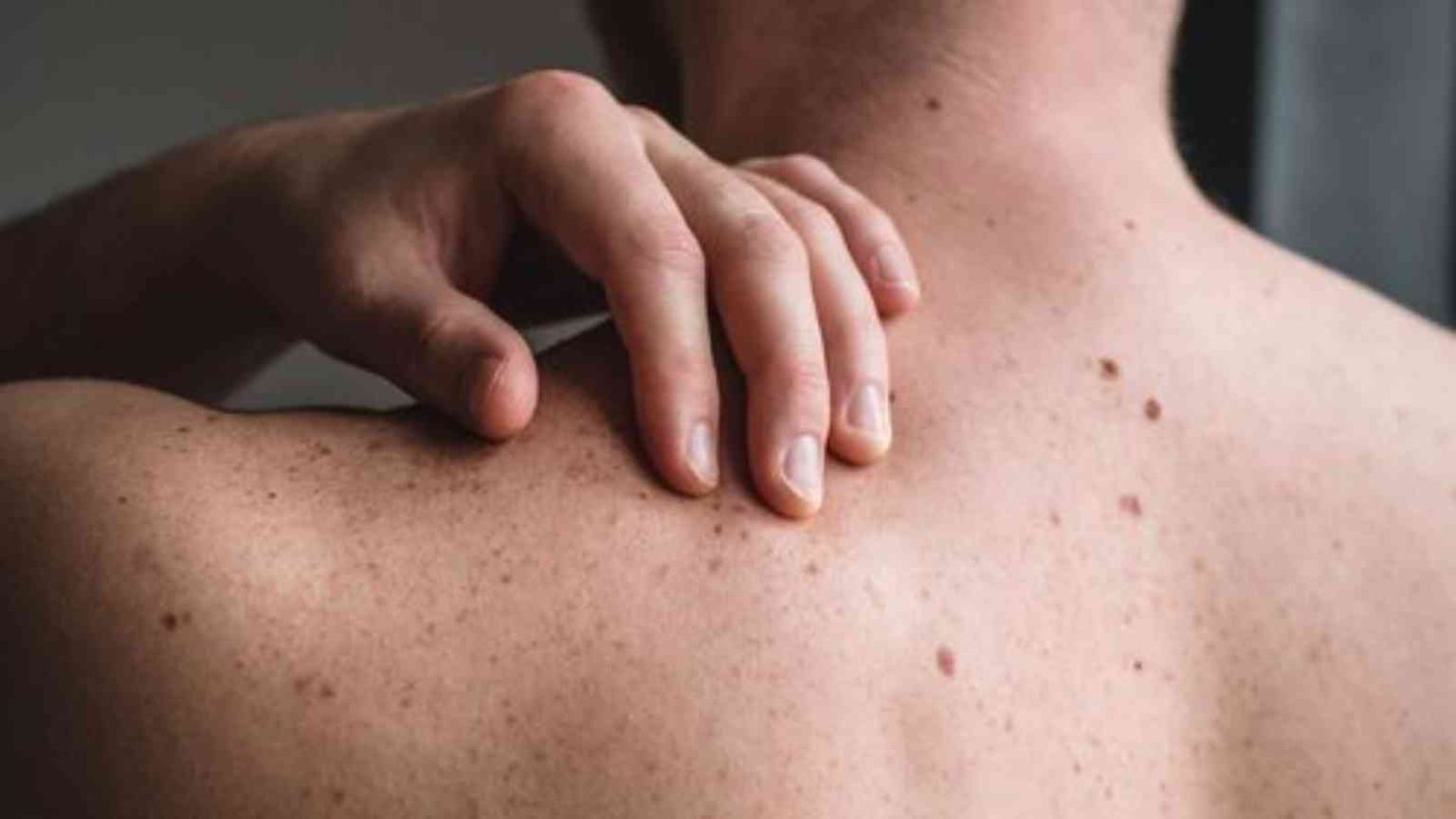 Melanoma Monday 2023 Date, History, Facts about Melanoma