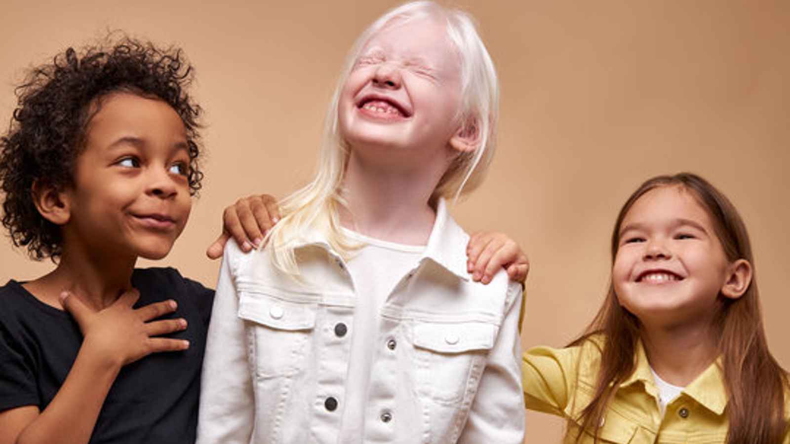 International Albinism Awareness Day 2023: Date, History, Facts about Albinism