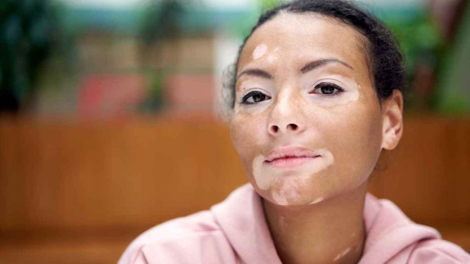 World Vitiligo Day 2023 Date, History, Facts about Vitiligo