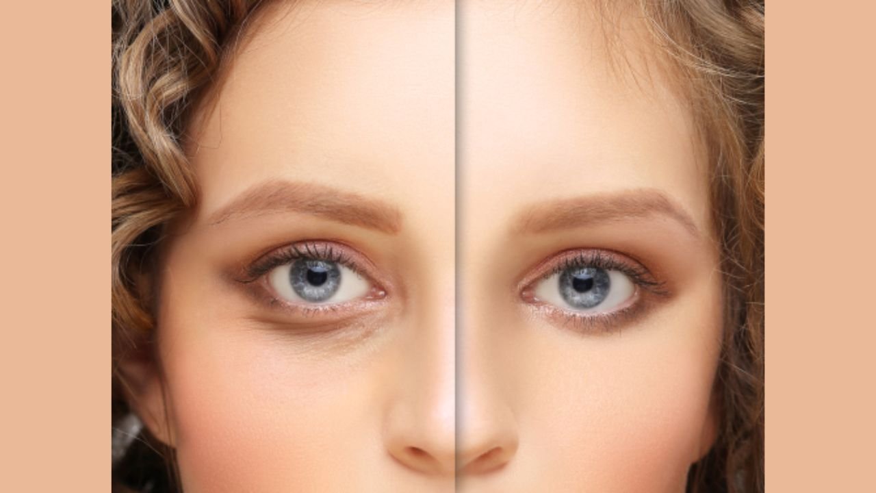 What Exactly is Blepharoplasty What Exactly is Blepharoplasty