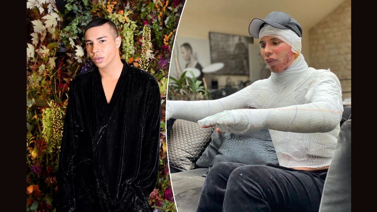 olivier rousteing plastic surgery Image 1