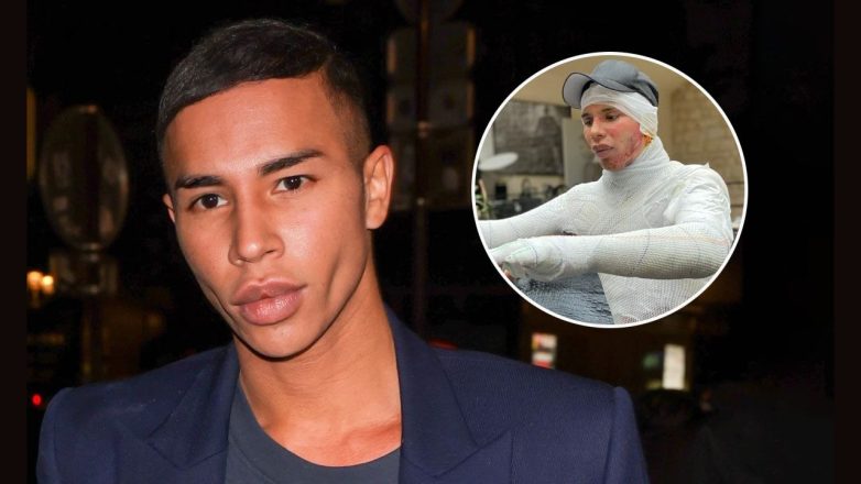 Olivier Rousteing Plastic Surgery: What Happened to His Burned Face?