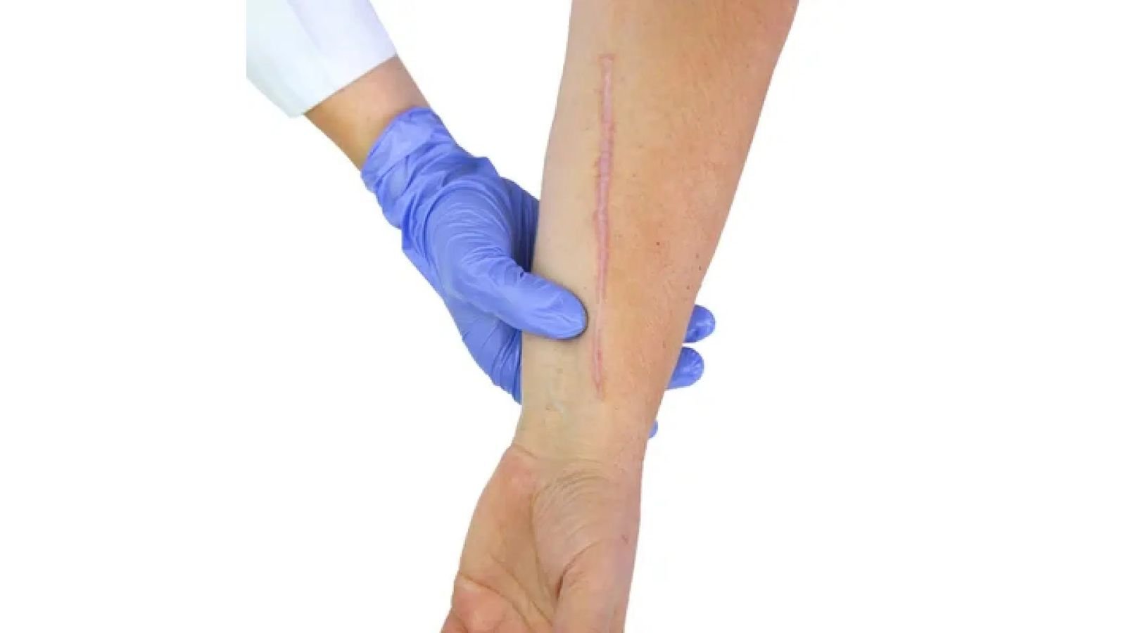 National Scar Appreciation Day 2023 National Scar Appreciation Day 2023