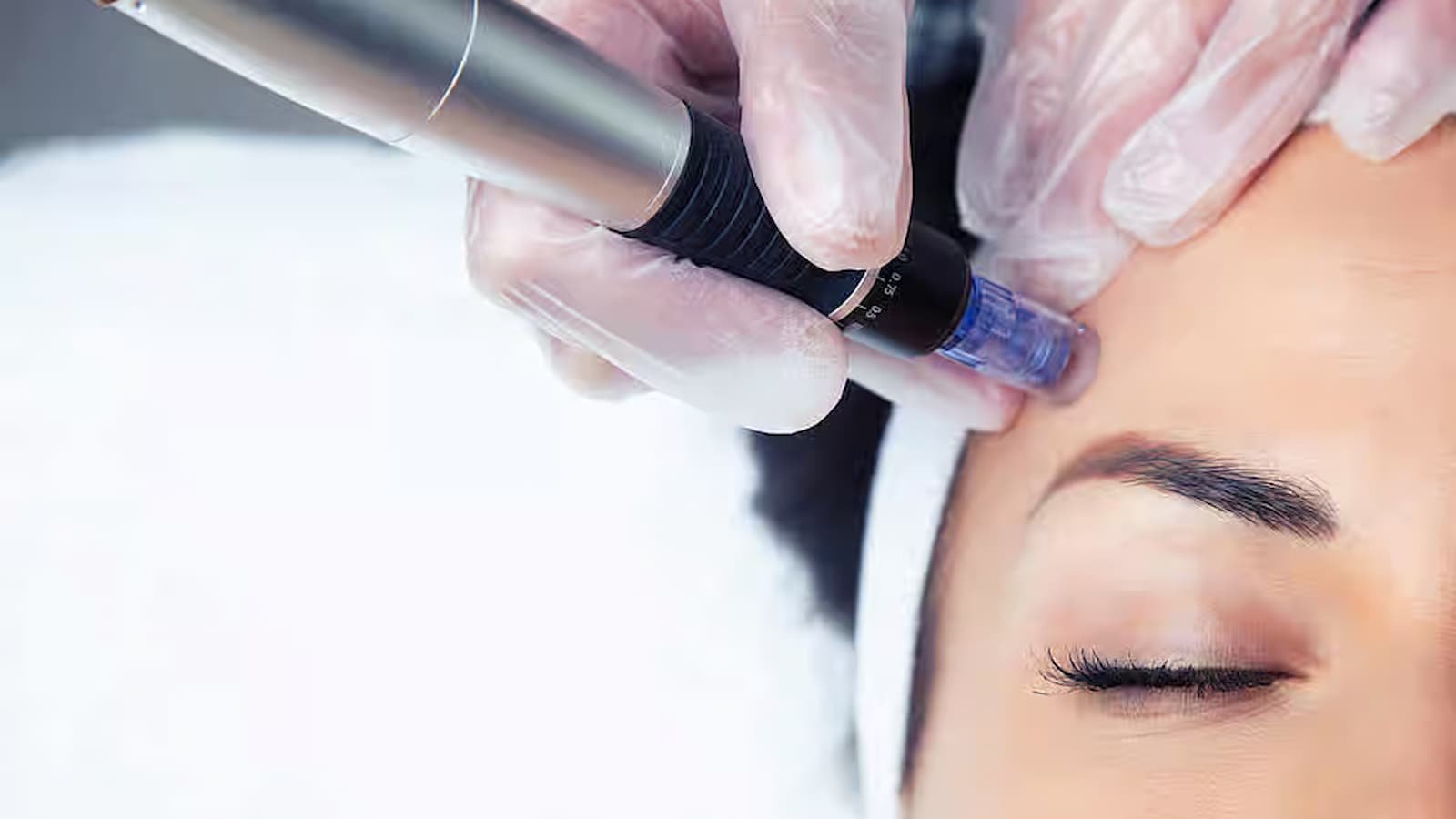 National Vivace Microneedling National Vivace Microneedling