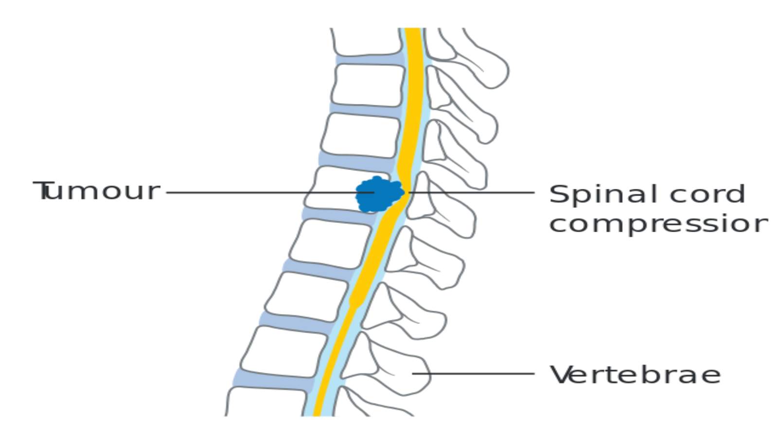 World Spine Day: Date, Background, Facts