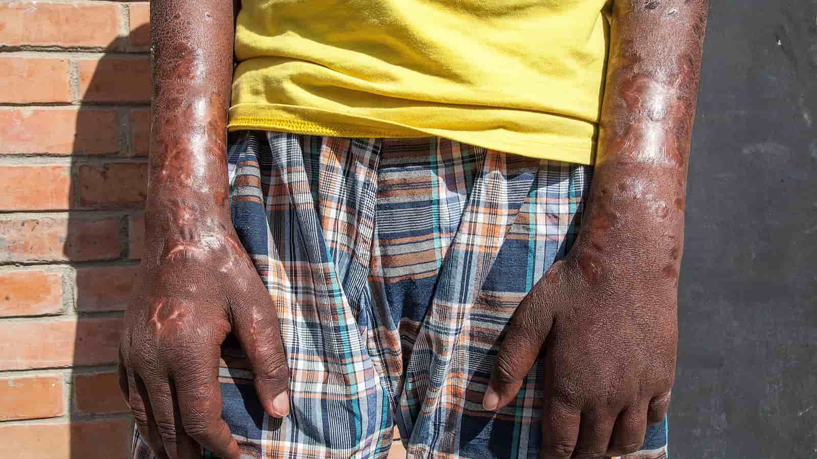 World Leprosy Day, World Leprosy Day 2024, Leprosy, Leprosy Day