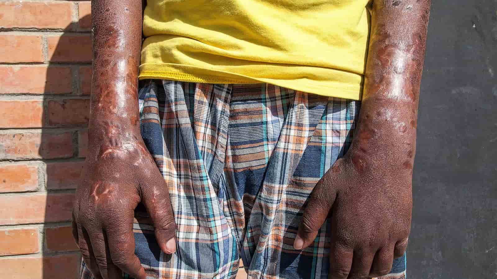World Leprosy Day World Leprosy Day, World Leprosy Day 2024, Leprosy, Leprosy Day